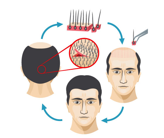 Hair Transplant Treatment CLINIC IN CHENNAI