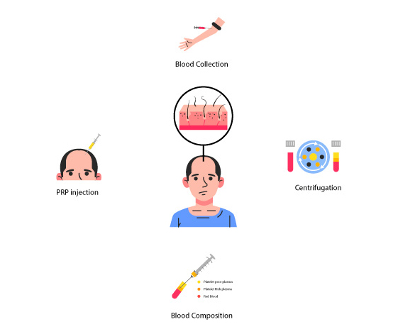 PRP FOR HAIR LOSS CLINIC IN CHENNAI