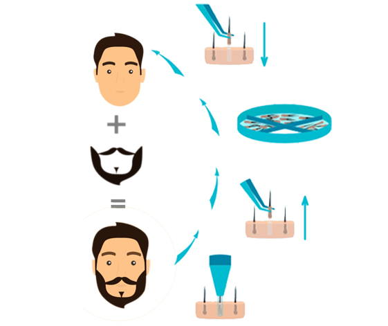 BEARD TRANSPLANT CLINIC IN CHENNAI