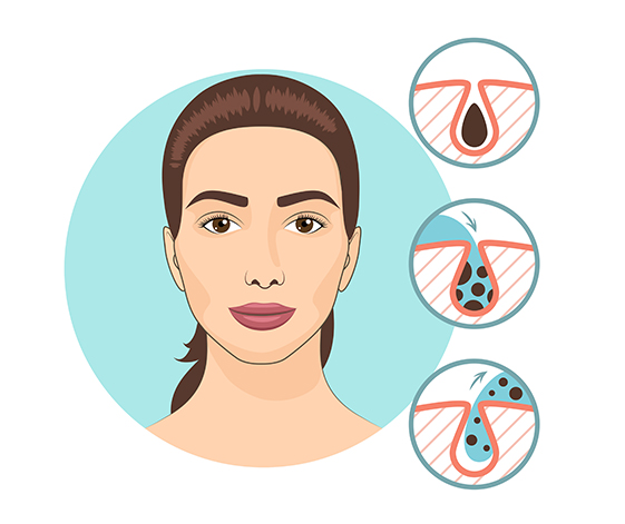 CHEMICAL PEELS Treatment CLINIC IN CHENNAI