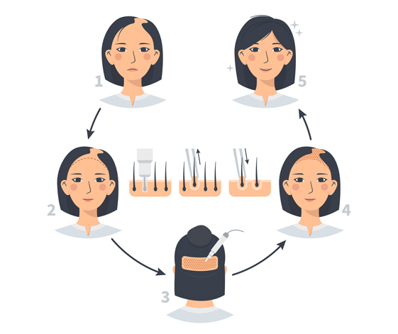 FEMALE HAIR TrANSPLANT CLINIC IN CHENNAI