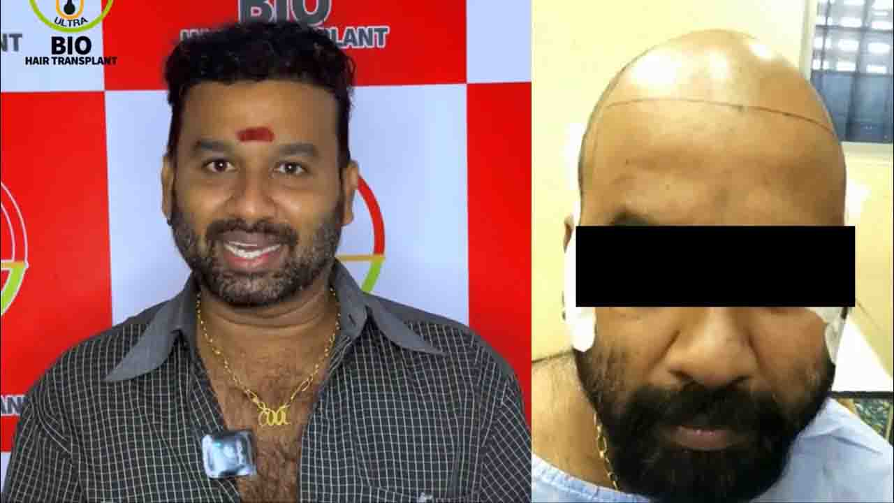 Actor Cool Suresh hair transplant treatment