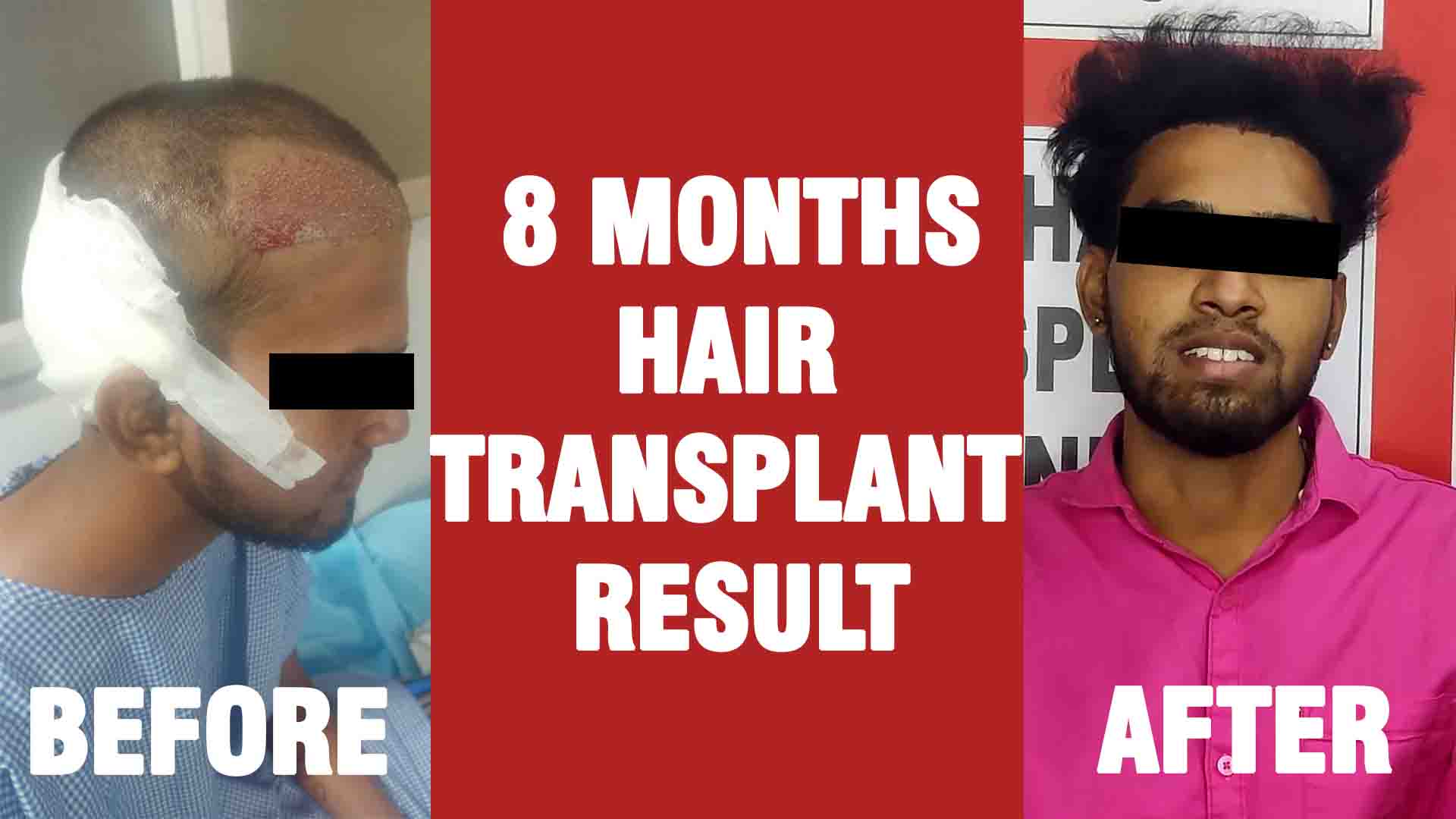 8 months hair transplant result