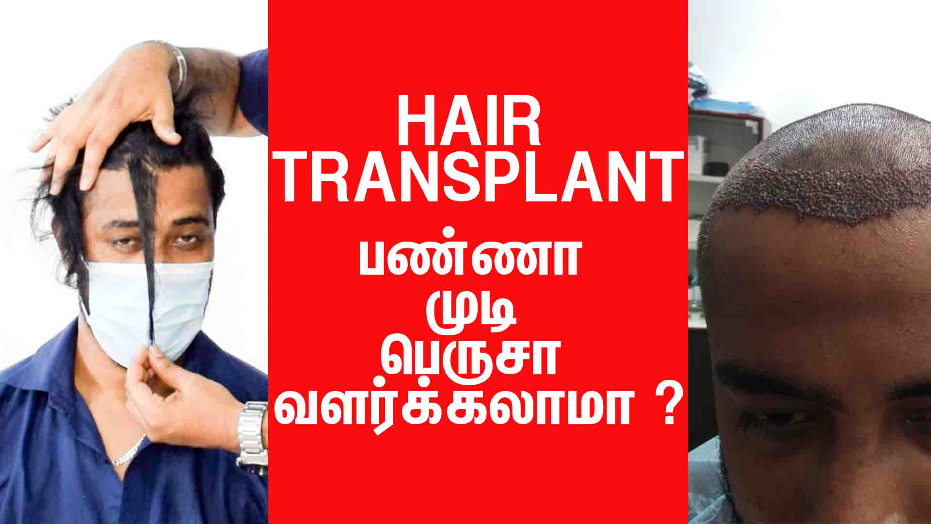 Long hair after hair transplant treatment
