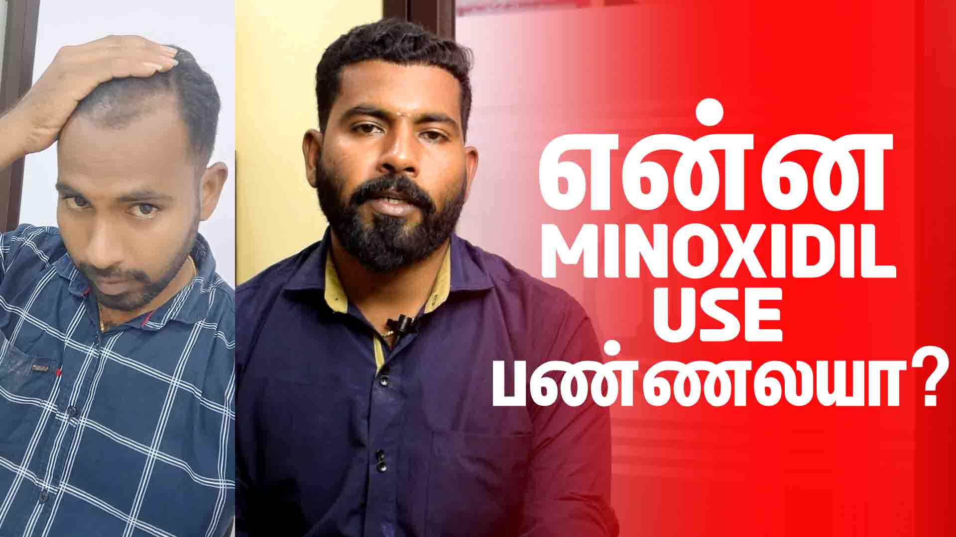 minoxidil for hair